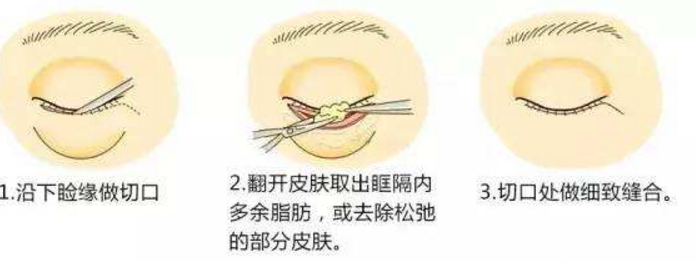 内切祛眼袋解决你眶隔脂肪多的问题
