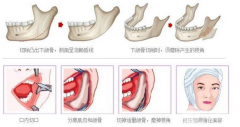 科普：磨骨是怎么样磨的？术前你得知道这些事……