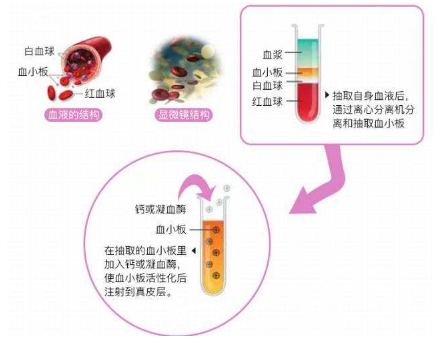 想要自体脂肪填充面部自然？这几点要注意！