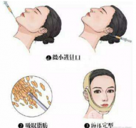 下巴吸脂手术的果：给你清晰的下颌缘线条