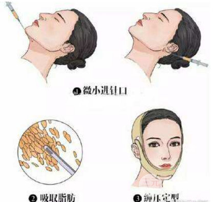 下巴吸脂手术的果:给你清晰的下颌缘线条