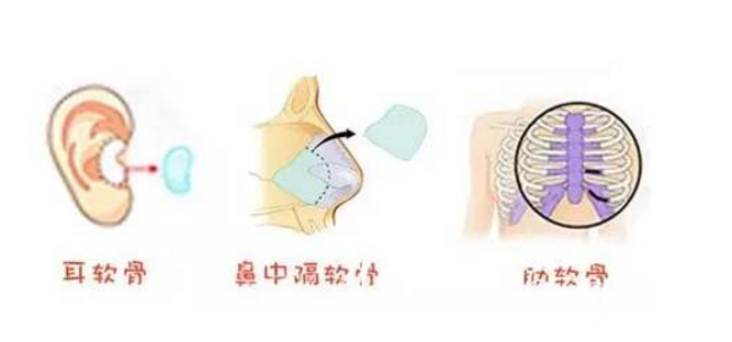 自软骨隆鼻：耳软骨、肋骨、鼻中隔，怎么选？