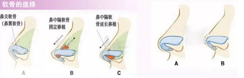 自软骨隆鼻：耳软骨、肋骨、鼻中隔，怎么选？