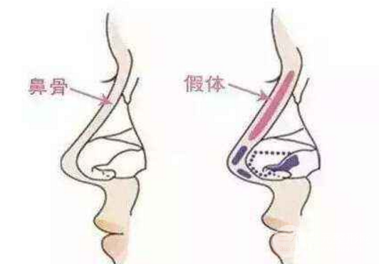 硅胶隆鼻成好吗