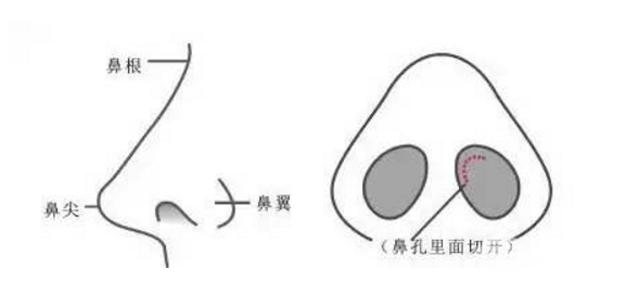 硅胶隆鼻成好吗