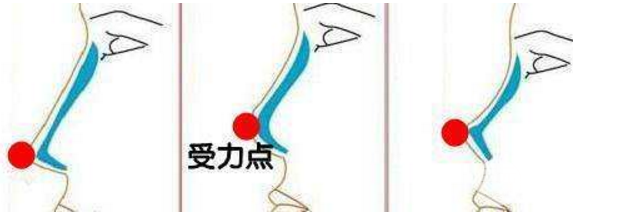 硅胶隆鼻成好吗