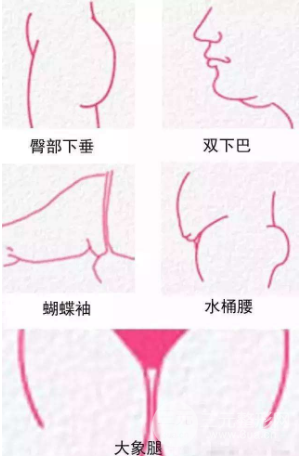 吸脂塑型手术能做哪些部位