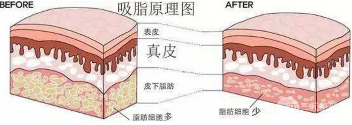 吸脂塑型手术能做哪些部位