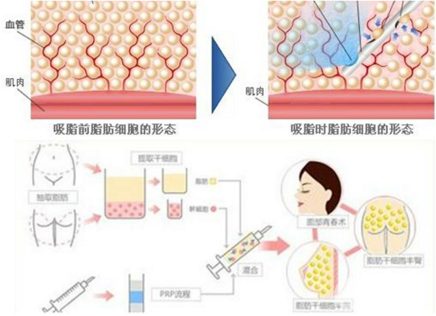 吸脂塑型手术能做哪些部位