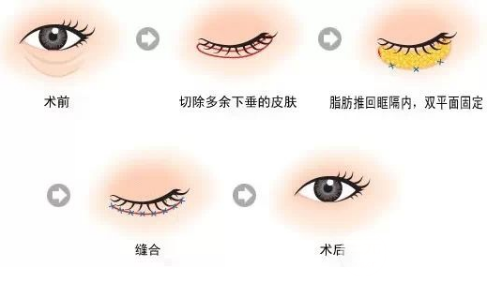 韩式去眼袋价格