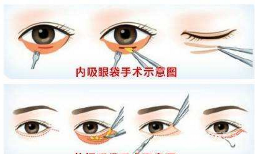 韩式去眼袋价格
