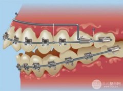 自锁托槽价格贵吗？牙齿矫正前先涨姿势！
