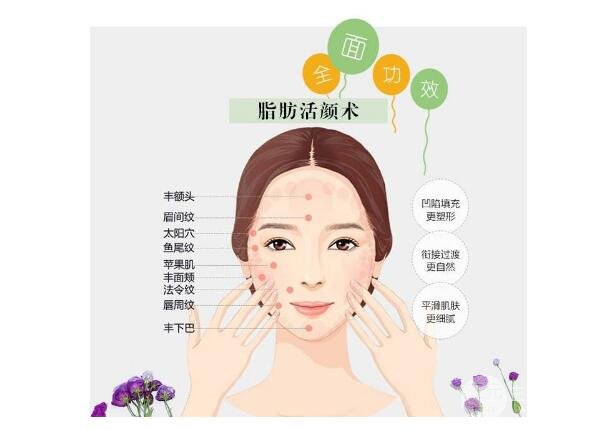 做过一次玻尿酸鼻唇沟除皱,原来果这么好~