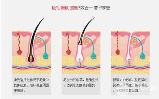 小腿激光脱毛价格