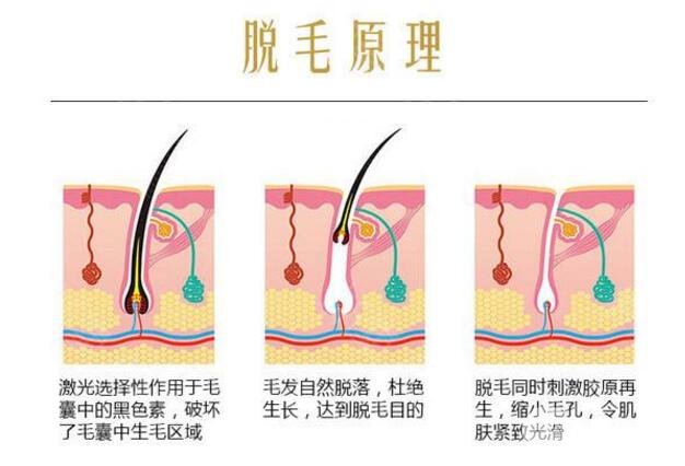 小腿激光脱毛价格