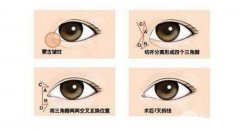 韩式开眼角整形有啥特点？科普韩团小姐姐都爱的整形项目~