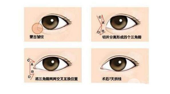 韩式开眼角整形有啥特点