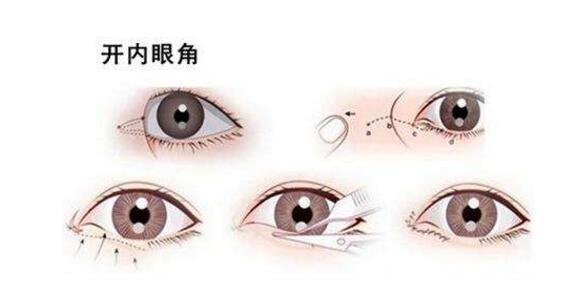 韩式开眼角整形有啥特点
