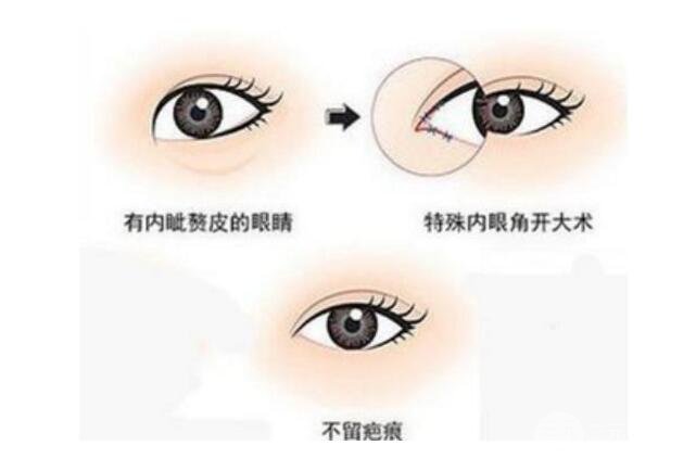 韩式开眼角整形有啥特点