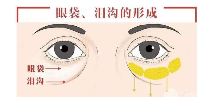 聚能美雕去眼袋多少钱