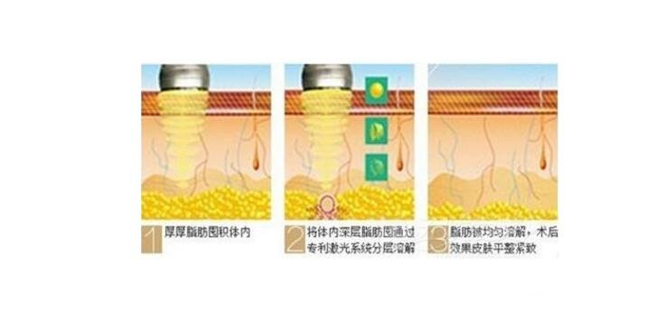 注射注射溶脂多久有果