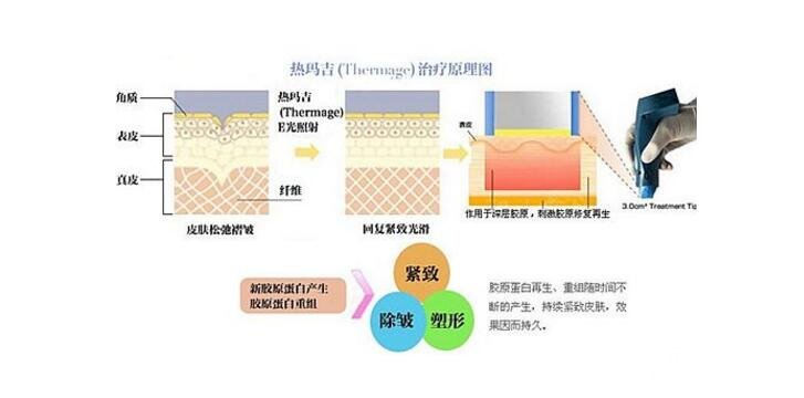 热玛吉紧肤多少钱