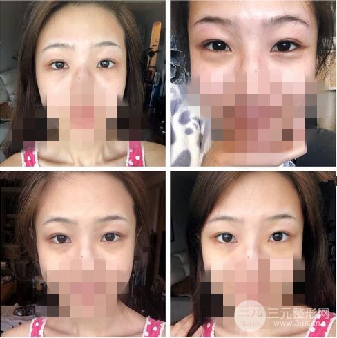 做的是内路去眼袋手术，让人烦恼的事情终于解决了