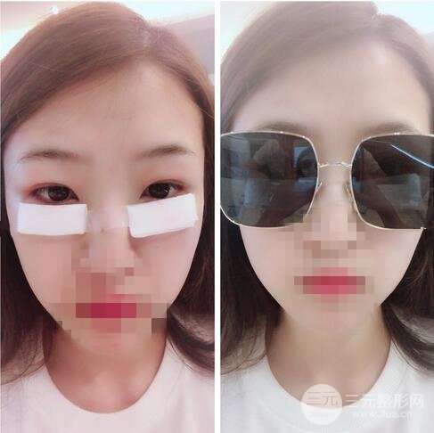 做的是内路去眼袋手术，让人烦恼的事情终于解决了