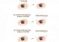 心血来潮介绍一下：微创双眼皮手术 真的微创吗？