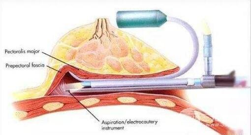 硅胶隆胸取出来后要如何重塑胸部美丽形态