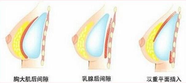 硅胶隆胸取出来后要如何重塑胸部美丽形态