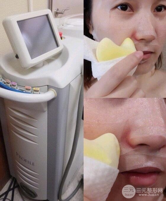彩光嫩肤祛痘