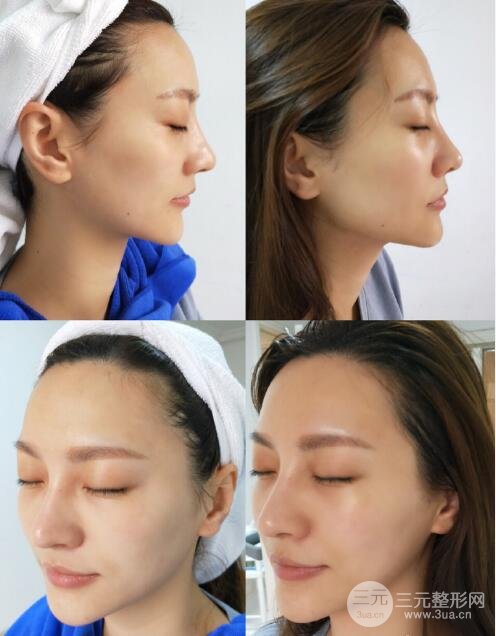 电波拉皮除皱术果