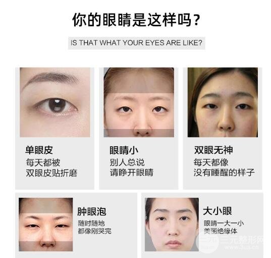 缝线双眼皮合适什么群体呢?