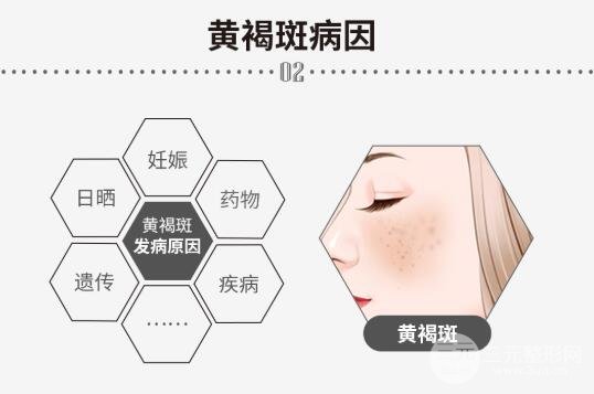 中医缓解黄褐斑