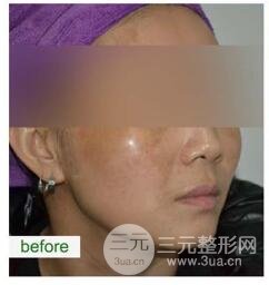 如何控制黄褐斑的扩散?