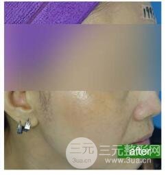 如何控制黄褐斑的扩散?