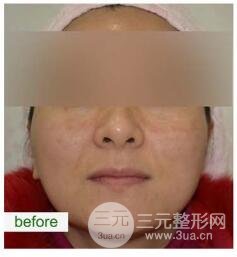 预防黄褐斑的出现和加重
