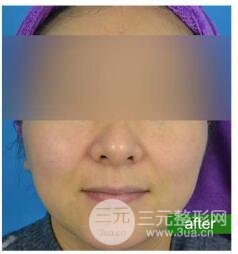 预防黄褐斑的出现和加重