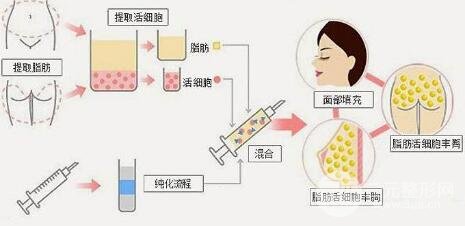 2020年自体脂肪填充手术的价格收费详情
