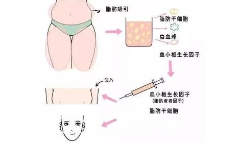 脂肪填充法令纹后，多久才可以大笑?