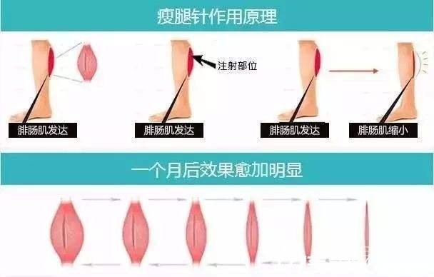 光纤溶脂瘦小腿好还是注射瘦腿好?