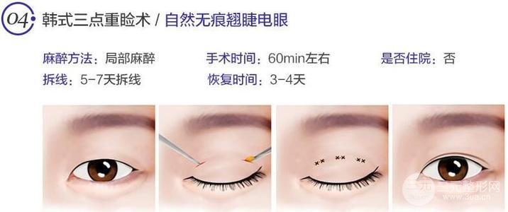 韩式微创双眼皮多少钱？
