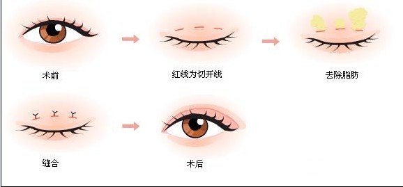 韩式微创双眼皮术后需要注意什么？