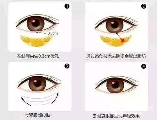 激光去眼袋手术价格