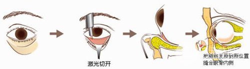 激光去眼袋手术价格