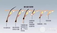怎样能长时间脱毛？脱毛注意事项有哪些？