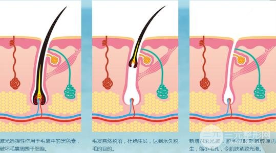 怎样能长时间脱毛？