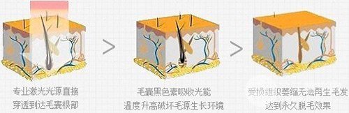 激光脱毛价格