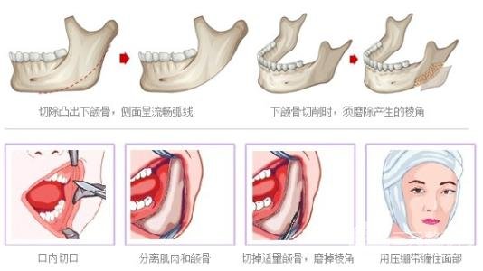 超声笔磨骨价格
